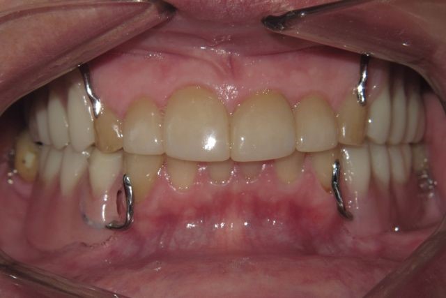 Acrylic Dentures Coffey MO 64636
